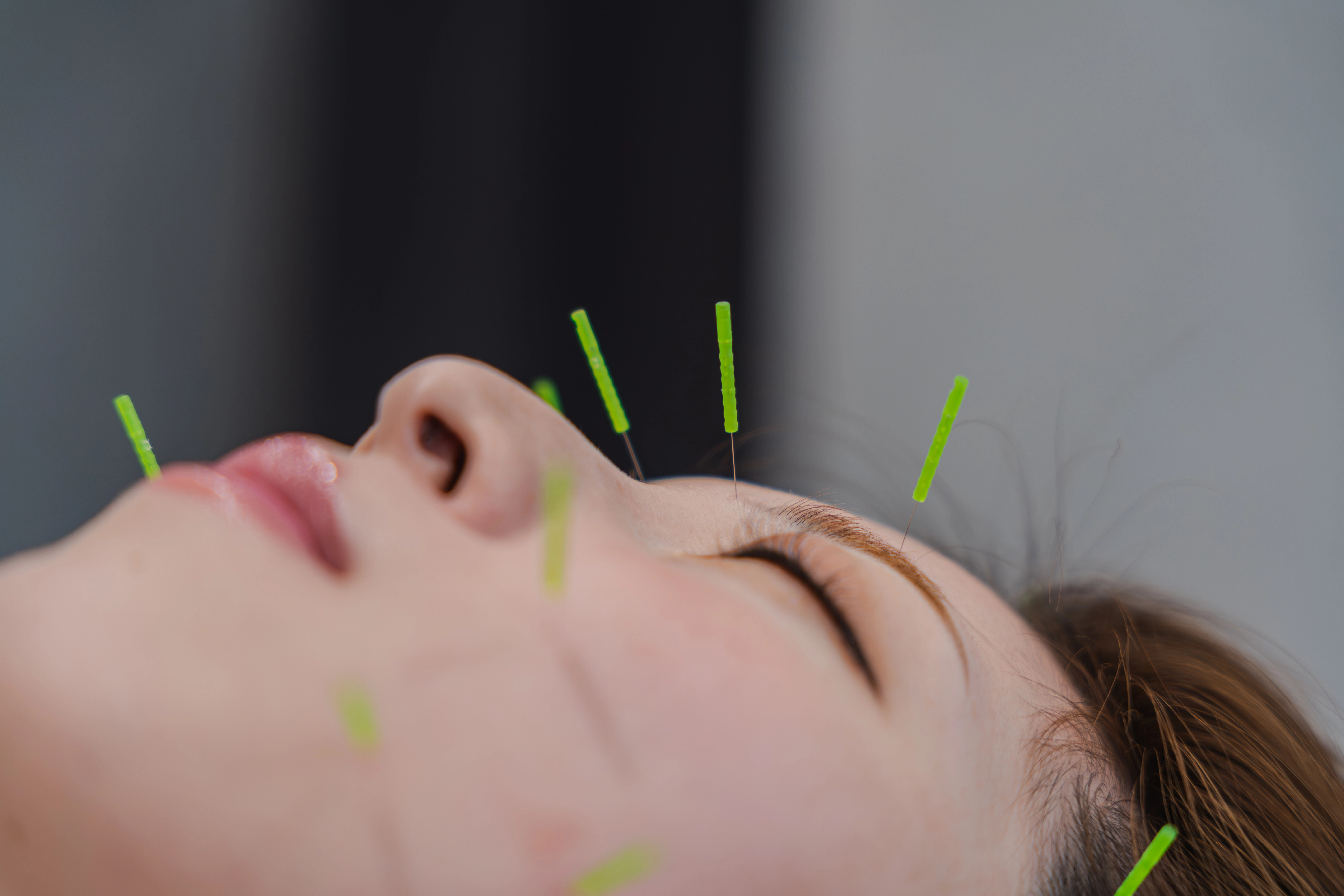 MITONOU式 輪郭美人鍼